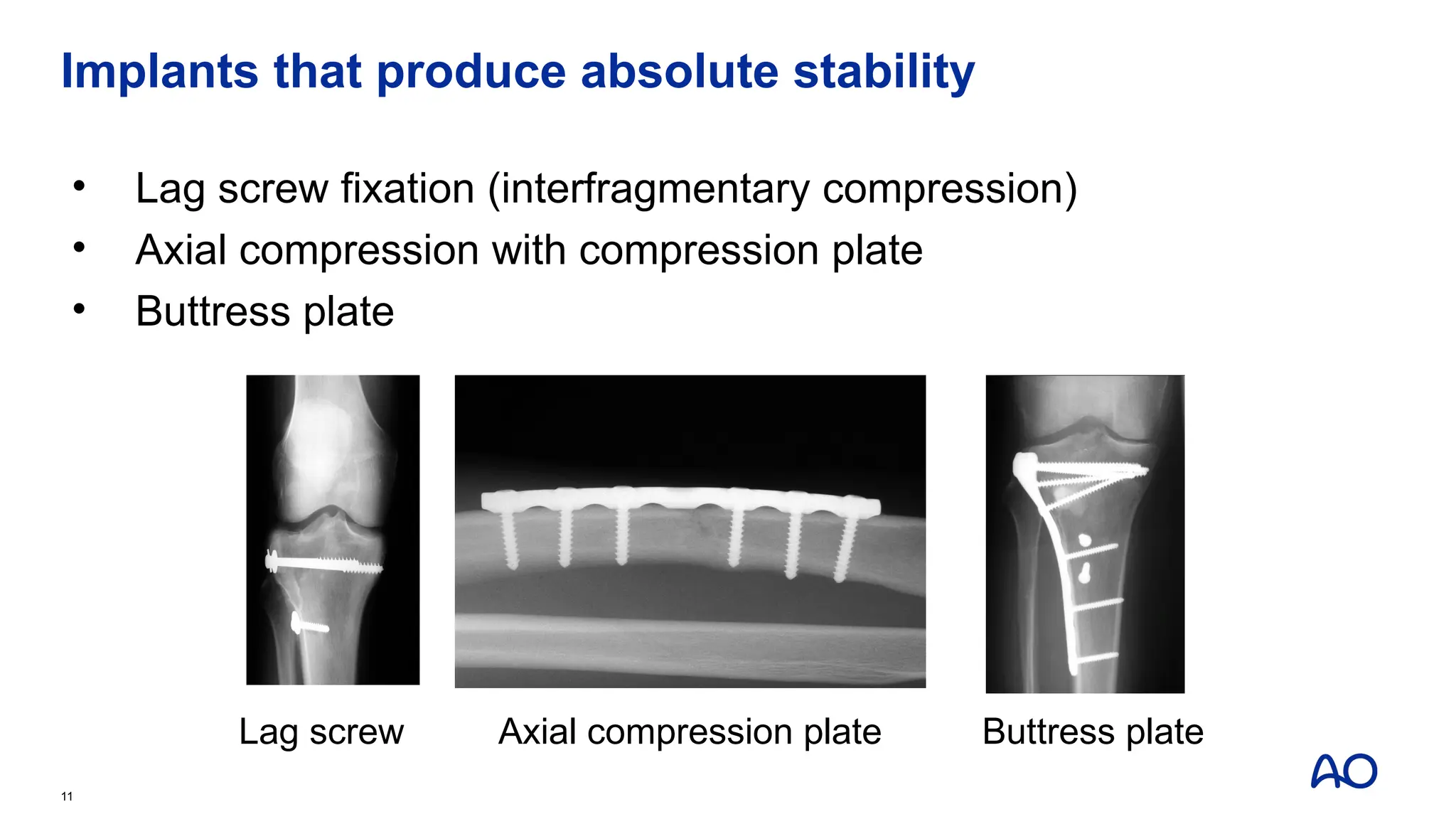 Implants that produce absolute stability
• Lag screw fixation (interfragmentary compression)
• Axial compression with compression plate
• Buttress plate
11
Lag screw Axial compression plate Buttress plate
 