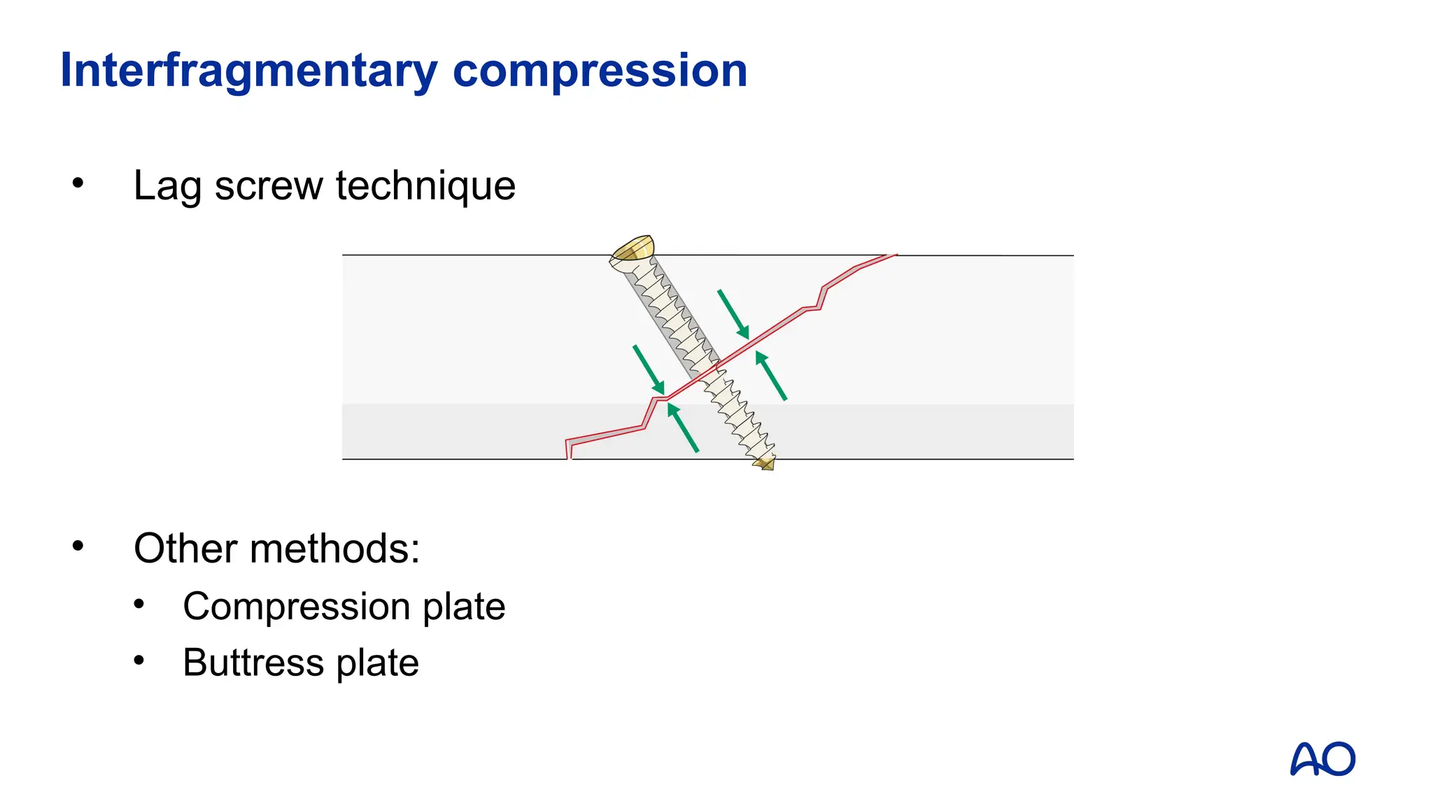Interfragmentary compression
• Lag screw technique
• Other methods:
• Compression plate
• Buttress plate
 