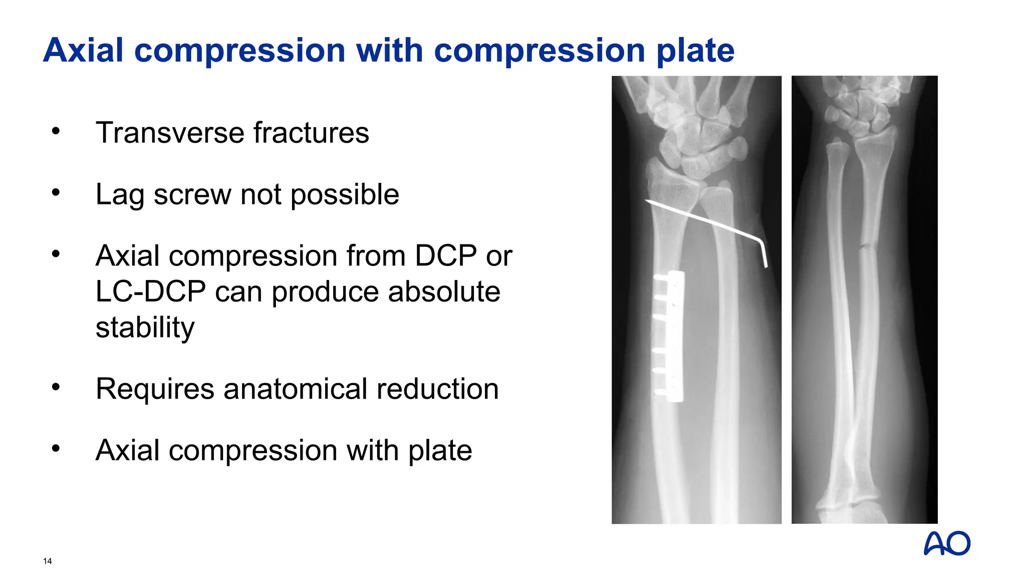 Axial compression with compression plate
• Transverse fractures
• Lag screw not possible
• Axial compression from DCP or
LC-DCP can produce absolute
stability
• Requires anatomical reduction
• Axial compression with plate
14
 