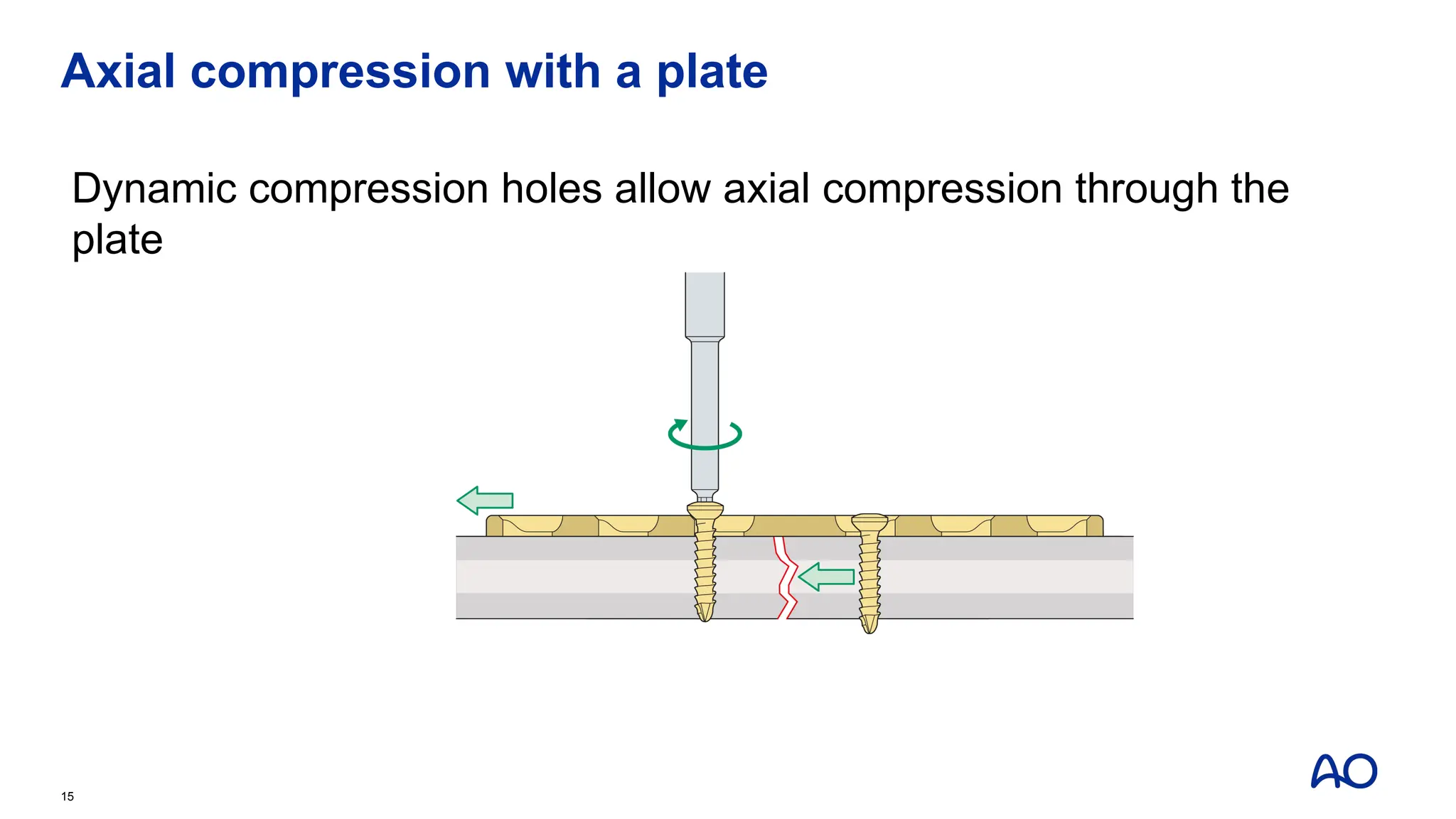 Axial compression with a plate
Dynamic compression holes allow axial compression through the
plate
15
 