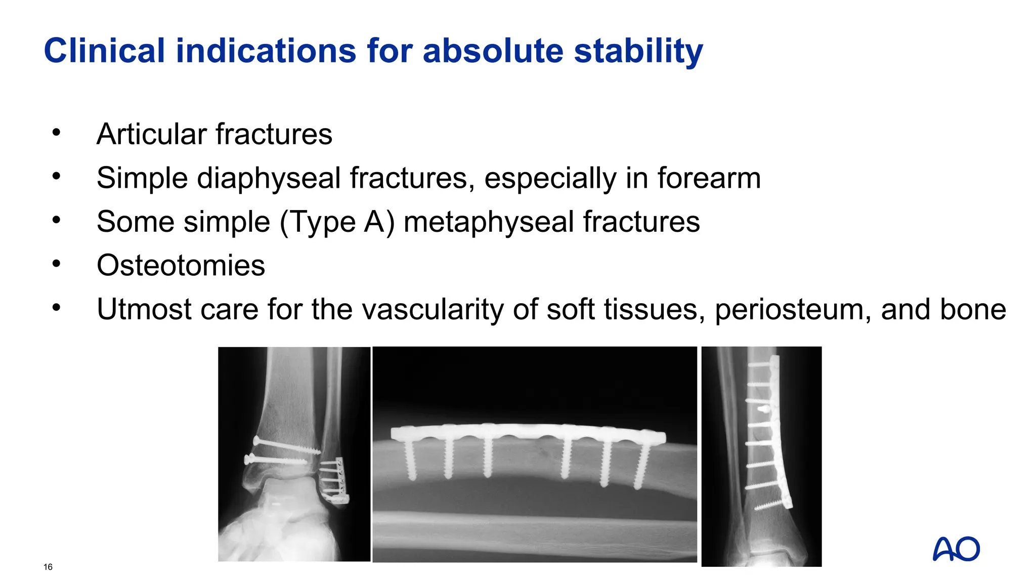 Clinical indications for absolute stability
• Articular fractures
• Simple diaphyseal fractures, especially in forearm
• Some simple (Type A) metaphyseal fractures
• Osteotomies
• Utmost care for the vascularity of soft tissues, periosteum, and bone
16
 