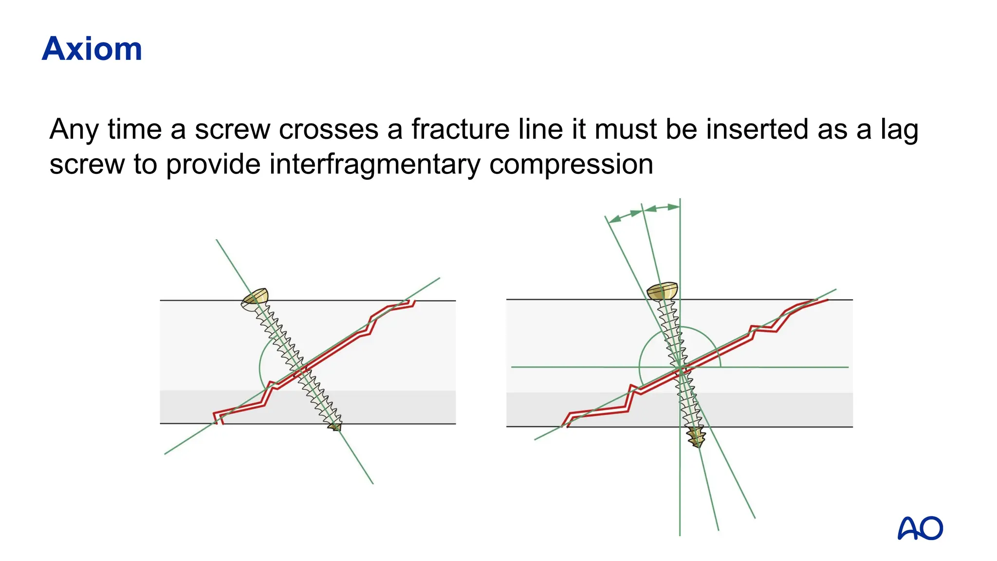 Axiom
Any time a screw crosses a fracture line it must be inserted as a lag
screw to provide interfragmentary compression
 