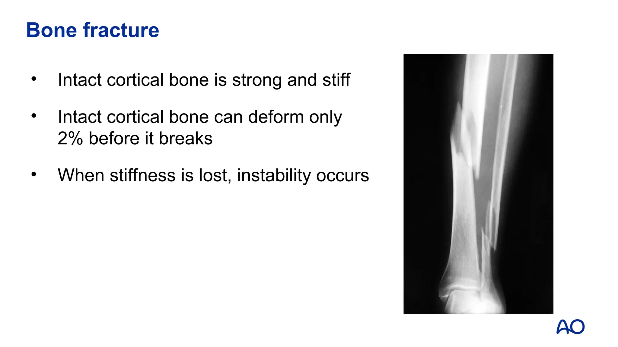 Bone fracture
• Intact cortical bone is strong and stiff
• Intact cortical bone can deform only
2% before it breaks
• When stiffness is lost, instability occurs
 