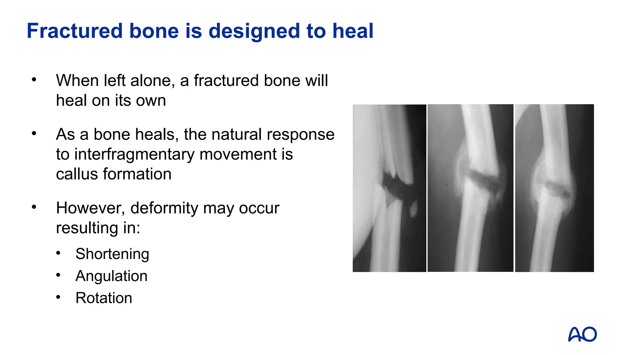 Fractured bone is designed to heal
• When left alone, a fractured bone will
heal on its own
• As a bone heals, the natural response
to interfragmentary movement is
callus formation
• However, deformity may occur
resulting in:
• Shortening
• Angulation
• Rotation
 