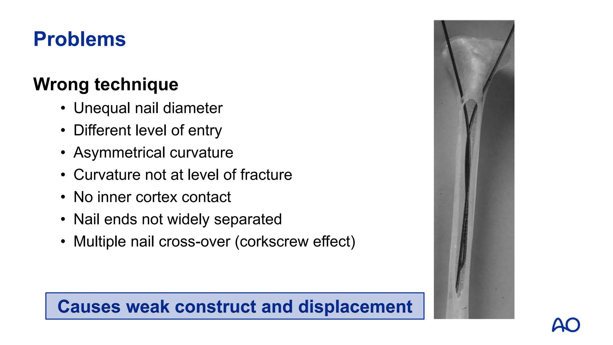 Cortexed Nail AO Trauma Pediatrics - Elastic nailing - M Kremli 2022.pptx