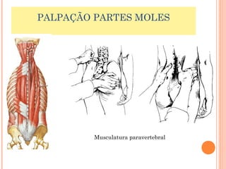 PALPAÇÃO PARTES MOLES 
Musculatura paravertebral 
 