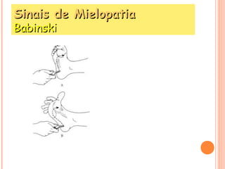 SSiinnaaiiss ddee MMiieellooppaattiiaa 
BBaabbiinnsskkii 
 