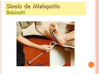 SSiinnaaiiss ddee MMiieellooppaattiiaa 
BBaabbiinnsskkii 
 