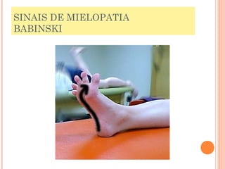 SINAIS DE MIELOPATIA 
BABINSKI 
 