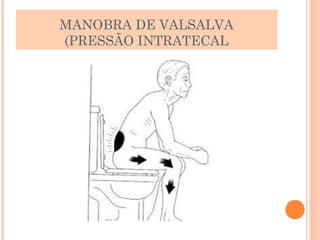 MANOBRA DE VALSALVA 
(PRESSÃO INTRATECAL 
 