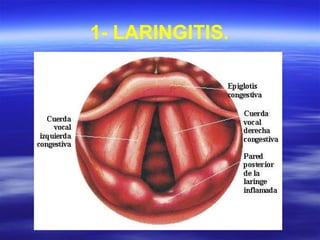 1- LARINGITIS.
 