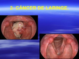 2- CÁNCER DE LARINGE.
 