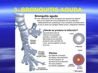 3- BRONQUITIS AGUDA.
 