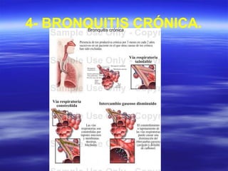 4- BRONQUITIS CRÓNICA.
 