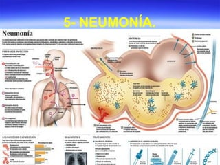 5- NEUMONÍA.
 