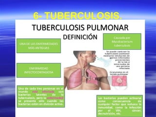 6- TUBERCULOSIS.
 