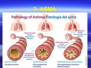 7- ASMA.
 
