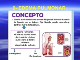 9- EDEMA PULMONAR.
 