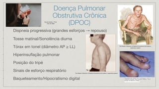 Doença Pulmonar
Obstrutiva Crônica
(DPOC)
• Dispneia progressiva (grandes esforços → repouso)
•
Tosse matinal/Sonolência diurna
•
Tórax em tonel (diâmetro AP ≥ LL)
•
Hiperinsuflação pulmonar
•
Posição do tripé
•
Sinais de esforço respiratório
•
Baqueteamento/Hipocratismo digital
The Netter Collection of Medical Ilustrations 2nd edition, respiratory system
The Netter Collection of Medical Ilustrations 2nd edition,
respiratory system
Revista Galileu- 19 de
maio de 2020
Baqueteamento digital como manifestação inicial de
neoplasia pulmonar, Alex Gonçalves Macedo; Escola
Paulista de Medicina, Unifesp;
 