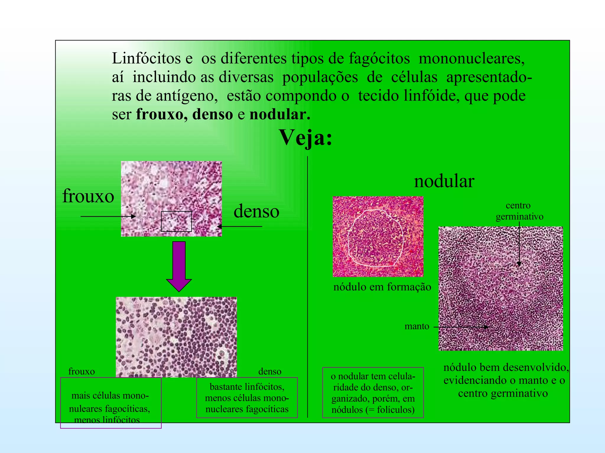 Linfócitos e  os diferentes tipos de fagócitos  mononucleares, aí  incluindo as diversas  populações  de  células  apresentado- ras de antígeno,  estão compondo o  tecido linfóide, que pode ser  frouxo, denso  e  nodular. Veja: frouxo denso mais células mono- nuleares fagocíticas, menos linfócitos bastante linfócitos, menos células mono- nucleares fagocíticas nodular nódulo em formação nódulo bem desenvolvido, evidenciando o manto e o centro germinativo o nodular tem celula- ridade do denso, or- ganizado, porém, em nódulos (= folículos) frouxo denso centro germinativo manto 