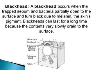 Blackhead: A blackhead occurs when the
trapped sebum and bacteria partially open to the
surface and turn black due to melanin, the skin's
pigment. Blackheads can last for a long time
because the contents very slowly drain to the
surface.
 