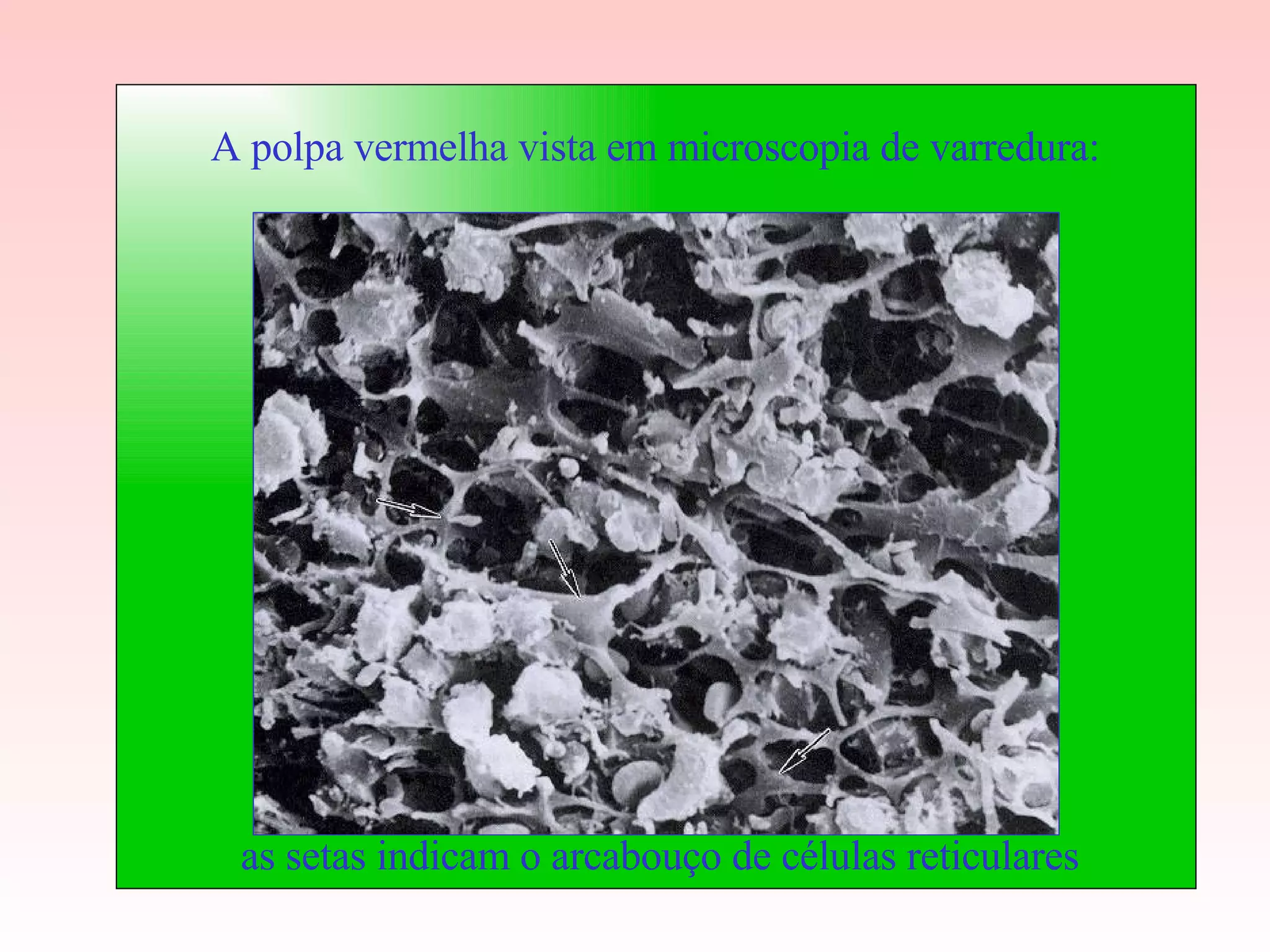 A polpa vermelha vista em microscopia de varredura: as setas indicam o arcabouço de células reticulares 