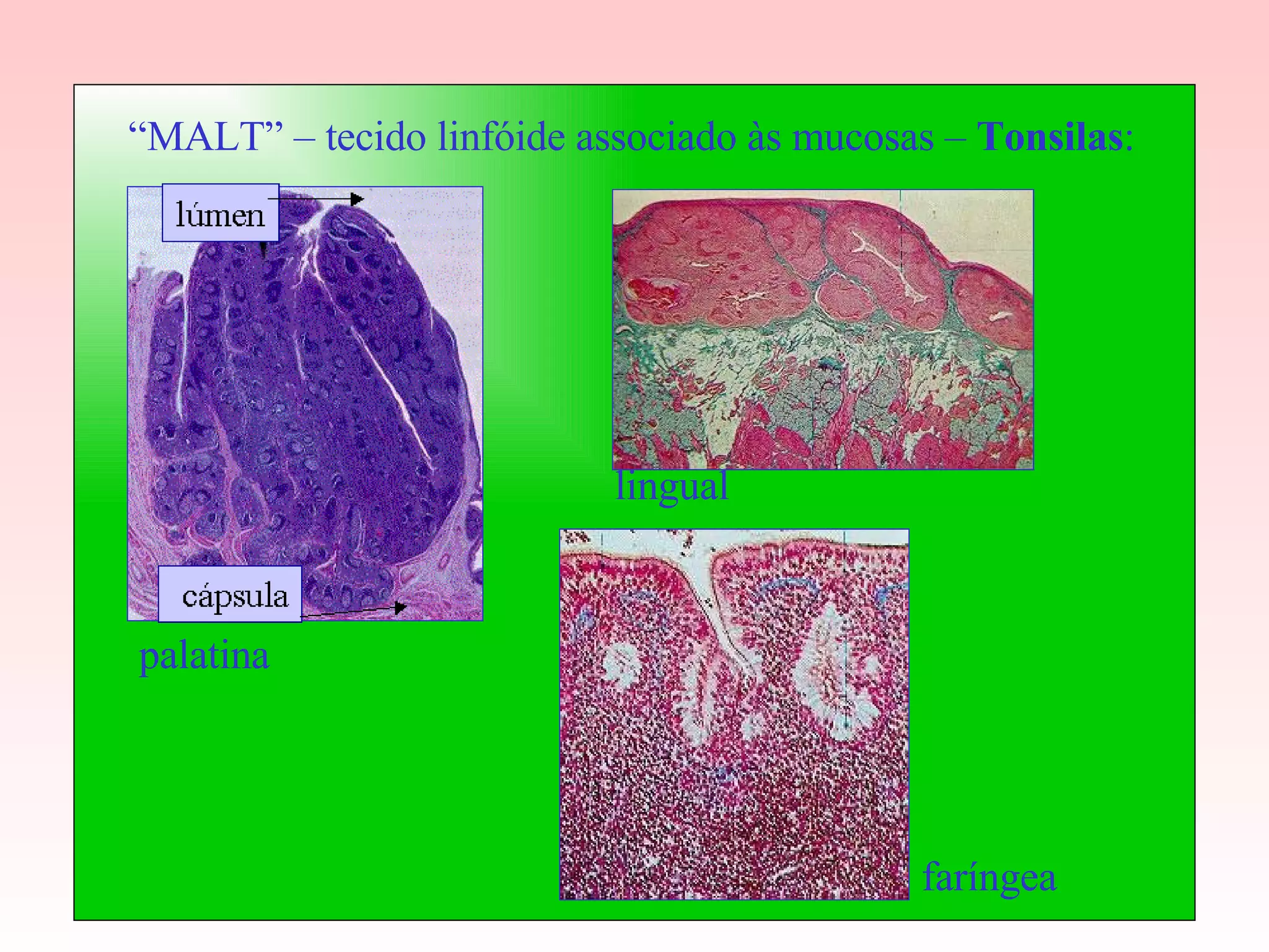 “ MALT” – tecido linfóide associado às mucosas –  Tonsilas : palatina lingual faríngea 