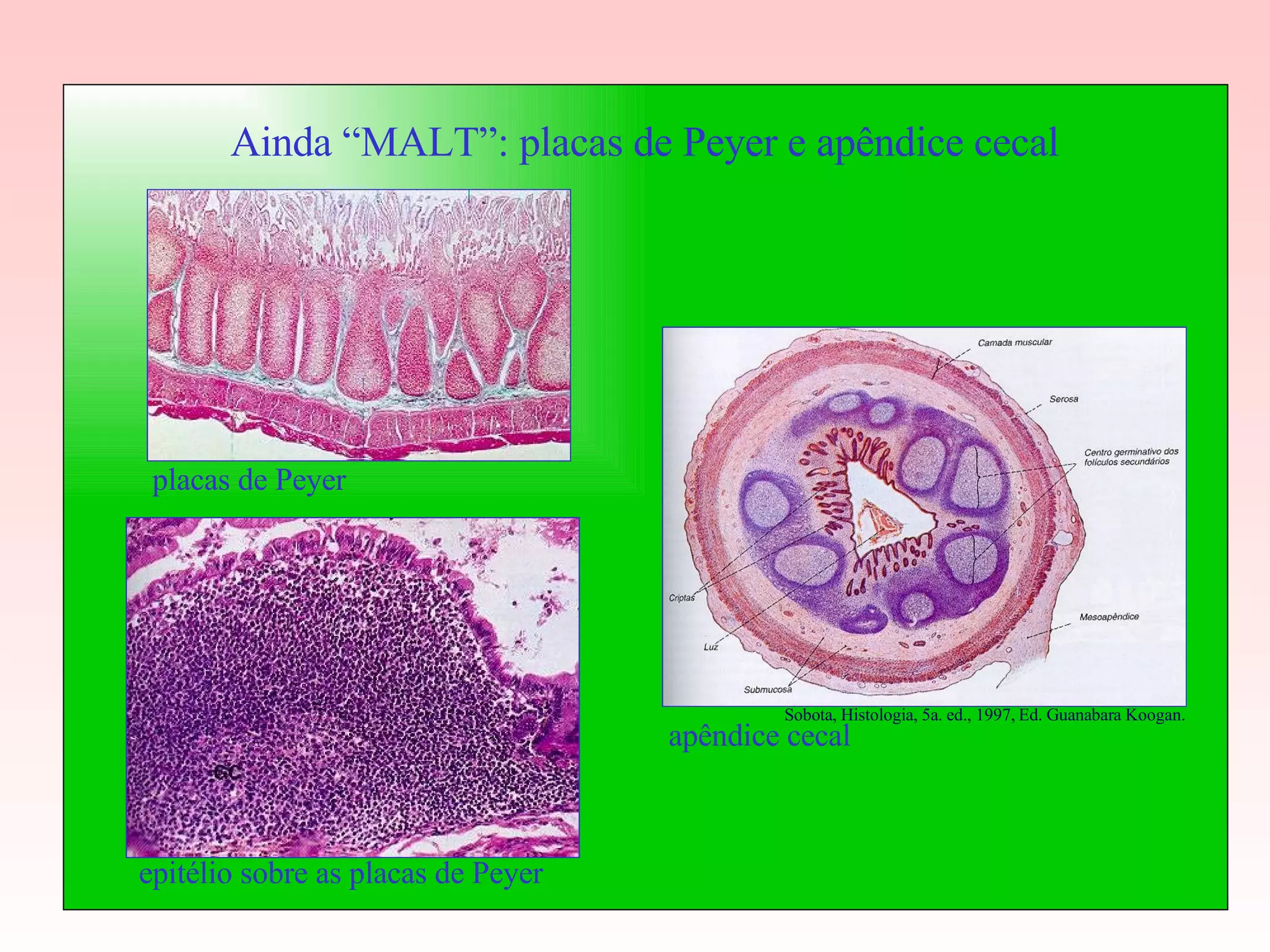 Ainda “MALT”: placas de Peyer e apêndice cecal placas de Peyer epitélio sobre as placas de Peyer apêndice cecal Sobota, Histologia, 5a. ed., 1997, Ed. Guanabara Koogan.  