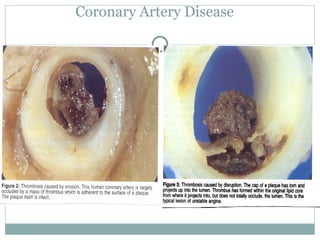 Coronary Artery Disease 