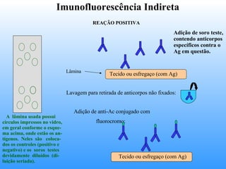 Imunofluorescência Indireta Lavagem para retirada de anticorpos não fixados:  Adição de anti-Ac conjugado com  fluorocromo: Adição de soro teste, contendo anticorpos específicos contra o Ag em questão. REAÇÃO POSITIVA A  lâmina usada possui círculos impressos no vidro, em geral conforme o esque- ma acima, onde estão os an- tígenos.  Neles  são  coloca- dos os controles (positivo e negativo) e os  soros  testes  devidamente  diluídos  (di- luição seriada). Lâmina Tecido ou esfregaço (com Ag)  Tecido ou esfregaço (com Ag)  