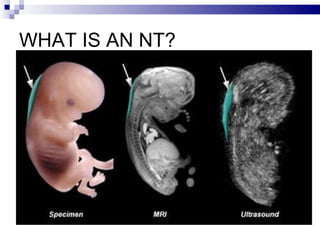 WHAT IS AN NT? 