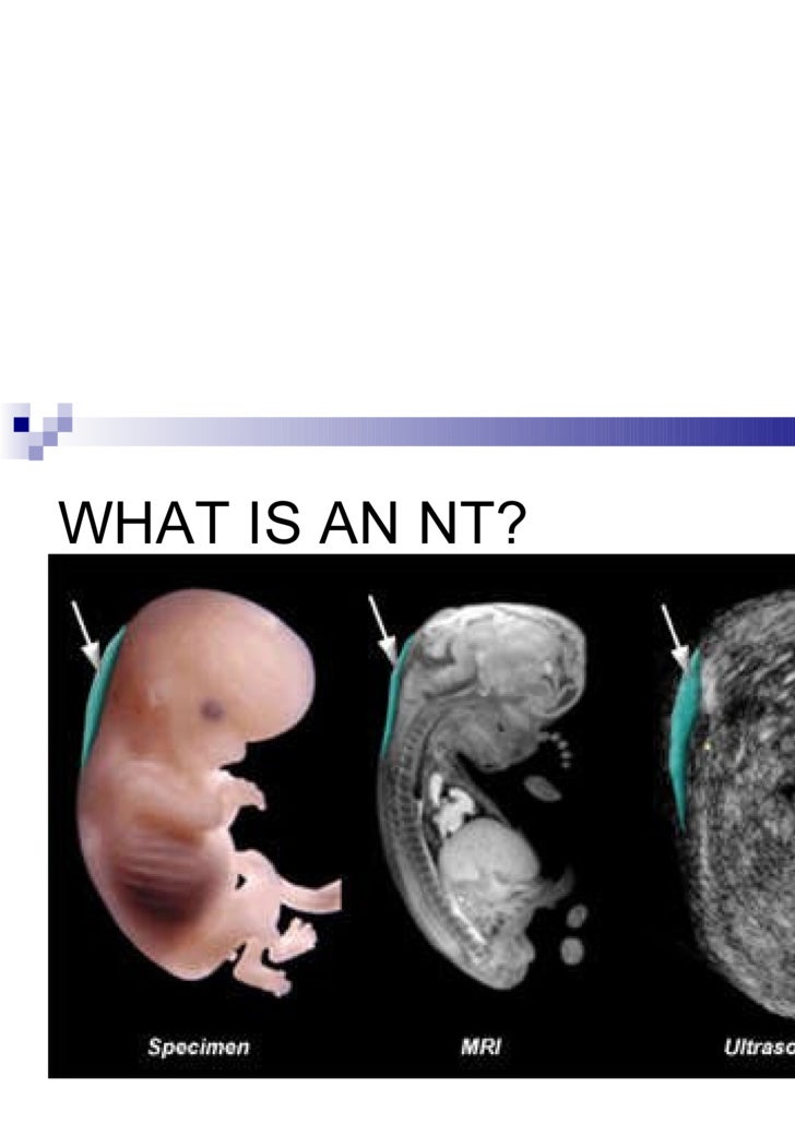 nuchal translucency screening nuchal translucency