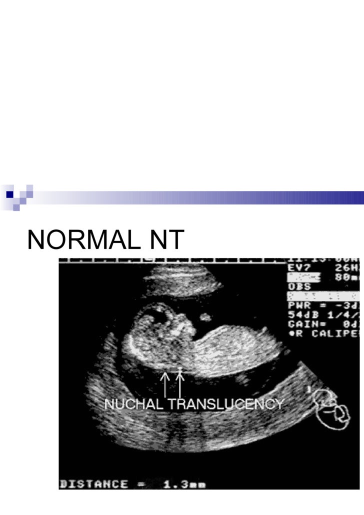nuchal-translucency-screening