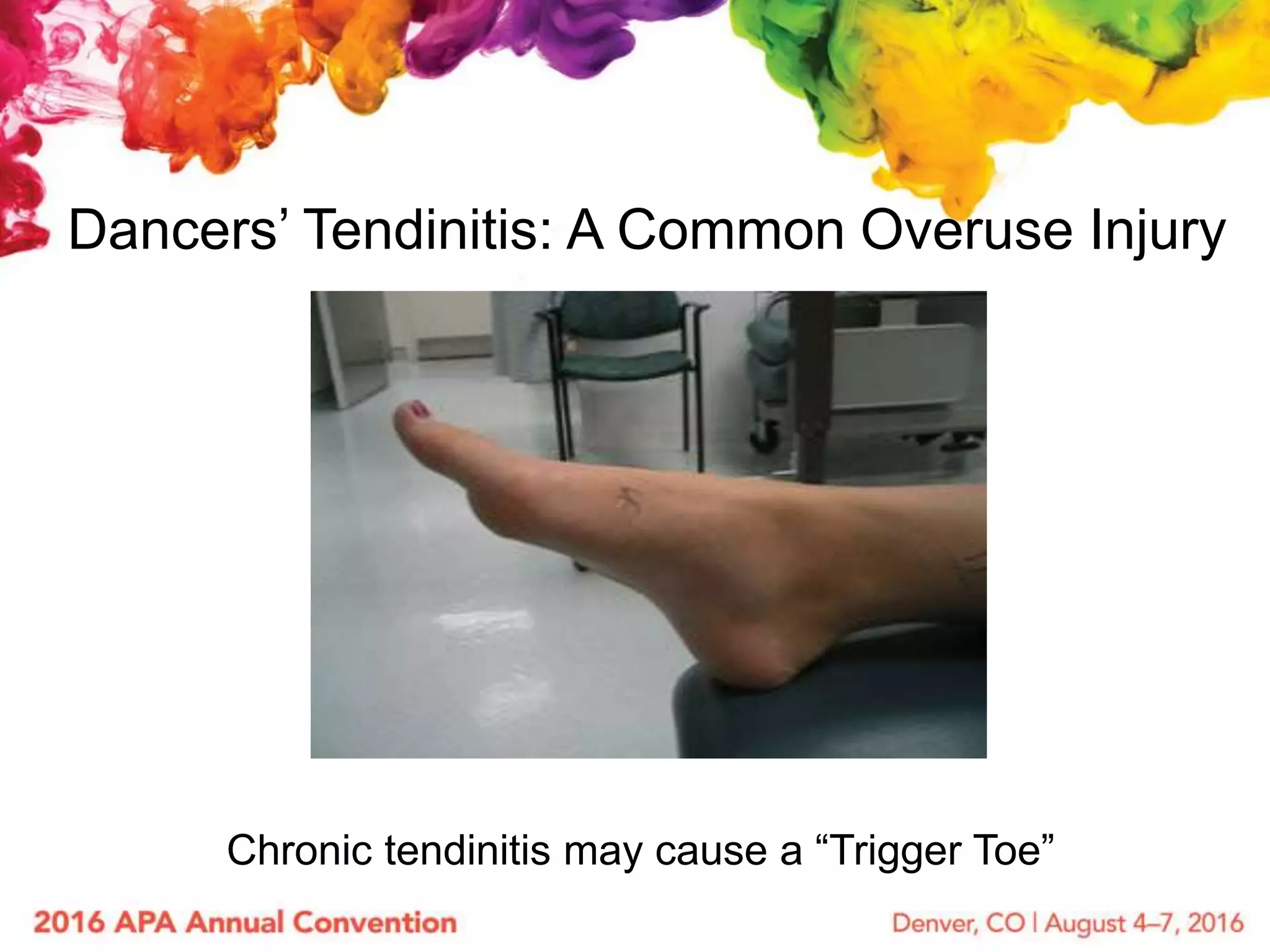 Dancers’ Tendinitis: A Common Overuse Injury
Chronic tendinitis may cause a “Trigger Toe”
 