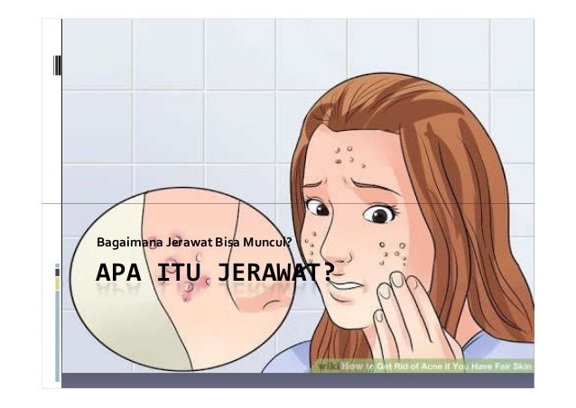 Apa Itu Jerawat Bagaimana Jerawat Muncul