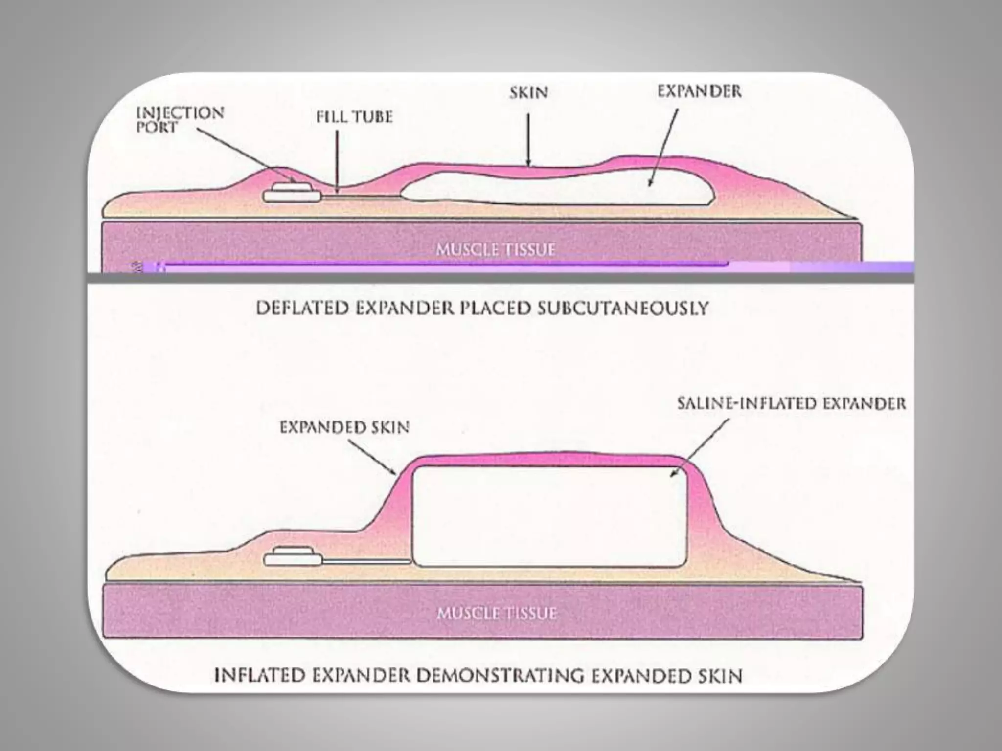 Spf Expander Tissue Expanders in OMFS | PPTX
