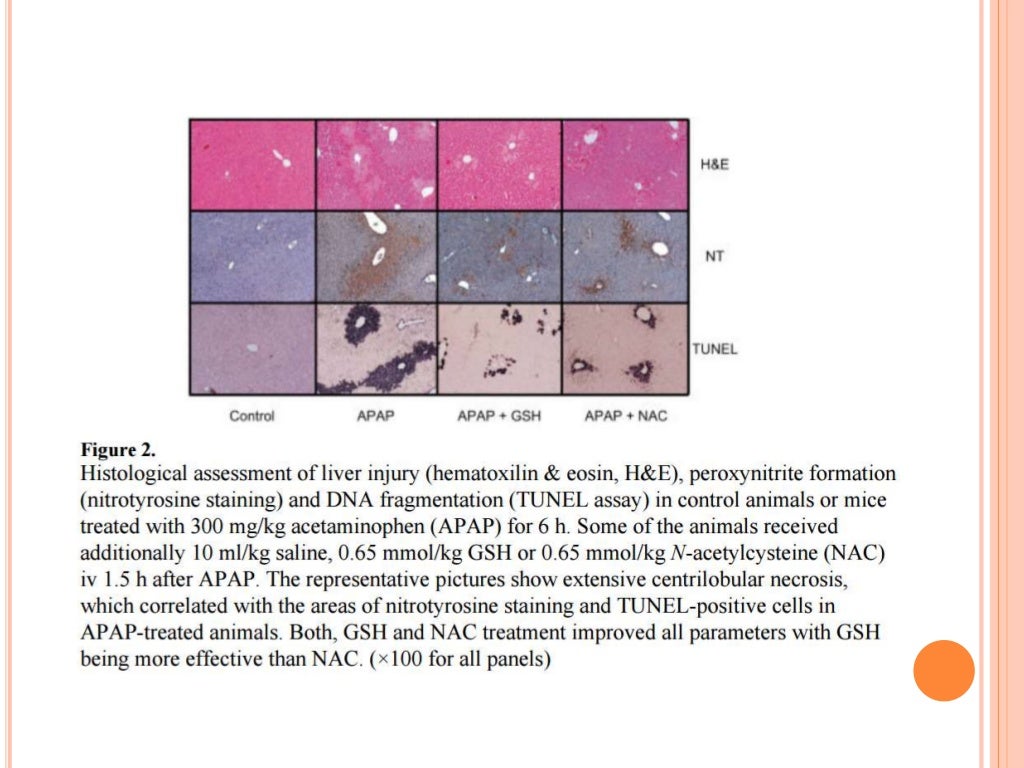 Paracetamol hepatotoxicity