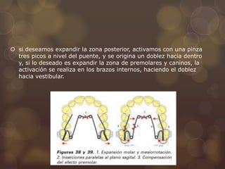  si deseamos expandir la zona posterior, activamos con una pinza
tres picos a nivel del puente, y se origina un doblez hacia dentro
y, si lo deseado es expandir la zona de premolares y caninos, la
activación se realiza en los brazos internos, haciendo el doblez
hacia vestibular.
 
