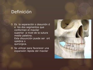 Definición
 Es la separación o desunión d
e los dos segmentos que
conforman el maxilar
superior a nivel de la sutura
media palatina.
Esta disyunción puede ser ort
opédica o
quirúrgica.
 Se utilizar para favorecer una
expansión rápida del maxilar
 