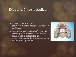 Disyunción ortopédica
 Utilizan aparatos que
provocan fuerzas pesadas , rápidas y
continuas
 Ocasionan una hialinización de las
piezas que se utilizan como pilares ,
provocando la estabilidad de
estos pilares para la separación de la
sutura media palatina .
 