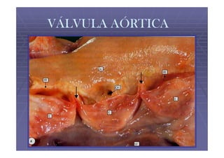 VÁLVULA AÓRTICA
 