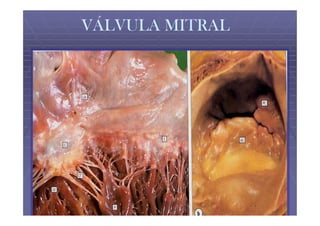VÁLVULA MITRAL
 