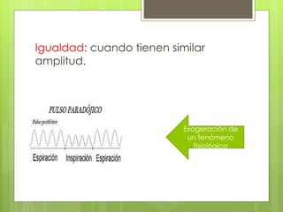 Igualdad: cuando tienen similar
amplitud.
Exageración de
un fenómeno
fisiológico
 