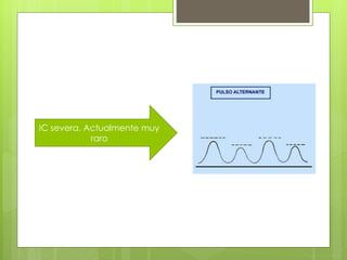 IC severa. Actualmente muy
raro
 