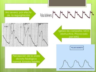 IAo severa: por efecto
de la regurgitación
Iglesia de campaña. MCH
obstructiva. Provocado
por MAS
Percepción de la onda
dicrota fisiológica
normal. Estados febriles
 