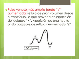 Pulso venoso más amplio (onda “V”
aumentada: reflujo de gran volumen desde
el ventrículo, lo que provoca desaparición
del colapso “X”. Aparición de una nueva
onda palpable de reflujo denominada “s”.
 