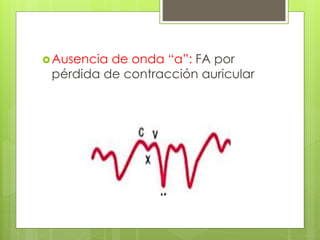 Ausencia de onda “a”: FA por
pérdida de contracción auricular
 