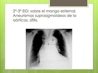 2°-3° EID: sobre el mango esternal.
Aneurismas suprasigmoideos de la
aórticos, sífilis.
 