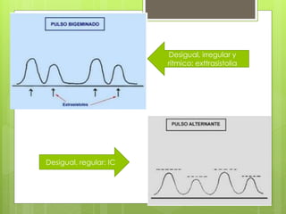 Desigual, irregular y
rítmico: exttrasistolia
Desigual, regular: IC
 
