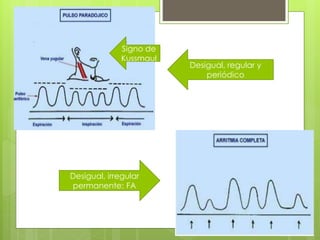 Desigual, regular y
periódico
Desigual, irregular
permanente: FA
Signo de
Kussmaul
 